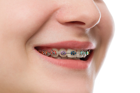 Closeup multicolored Braces on Teeth. Beautiful Female Smile portrait with Self-ligating Braces....