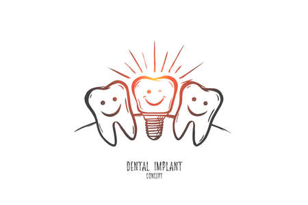Dental implant concept. Hand drawn dental implant model. Implant tooth isolated vector illustration.のイラスト素材