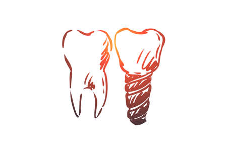 Implant, dental, tooth, health, care concept. Hand drawn healthy tooth and implant concept sketch. Isolated vector illustration.のイラスト素材