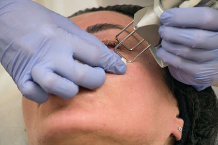 Laser skin rejuvenation, eyelid correction, pigmentation removal, close-upの写真素材