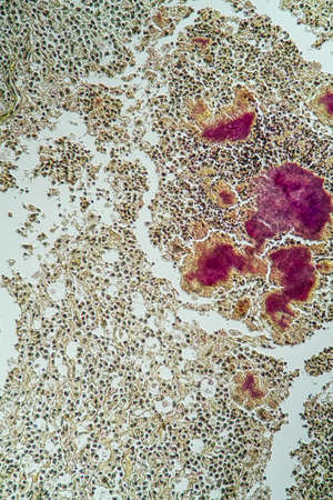 Actinomyces disease under the microscope 100x