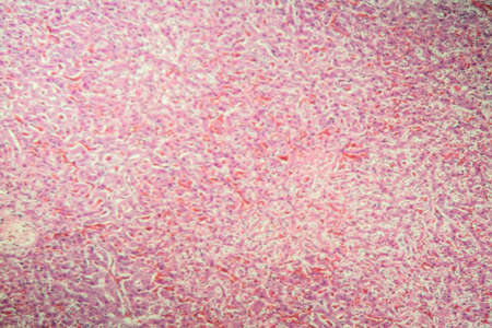 Hedgehog kidney after accident shock 100x
