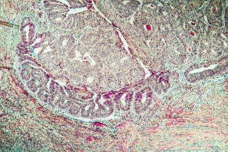 Colon carcinoma arising from adenoma, 100xの写真素材