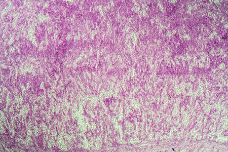 lungs Infection with Candida and Aspergillus in AIDS patients 200x