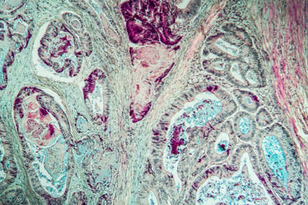 Colon carcinoma tissue thin section 100xの写真素材