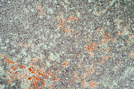 diseased ear tissue infected with Aspergillus 200x