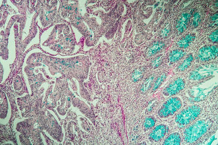 Colon cancer tissue under the microscope 100x
