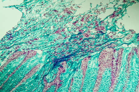 Colon cancer tissue under the microscope 100xの写真素材