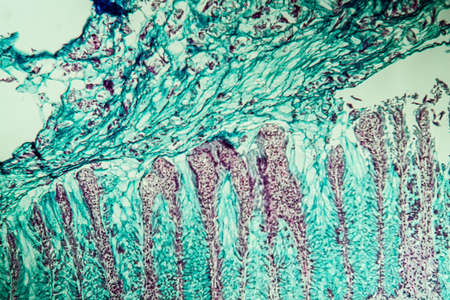 Colon cancer tissue under the microscope 100x