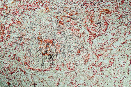 lungs Infection with Candida and Aspergillus in AIDS patients 200x