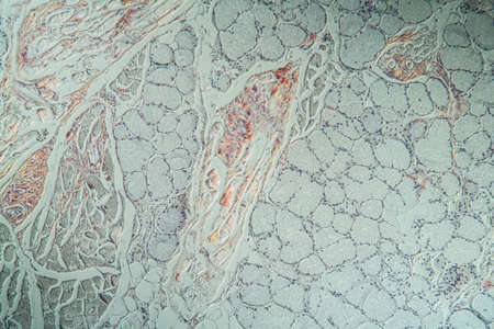 Tongue with amyloid deposits of sick tissue under the microscope 200x