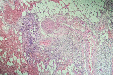 Colon inflammation in Crohn's disease 100x