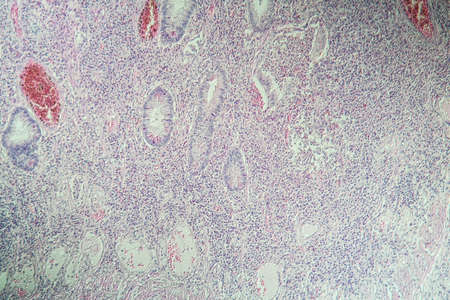 Colon inflammation in Crohn's disease 100x