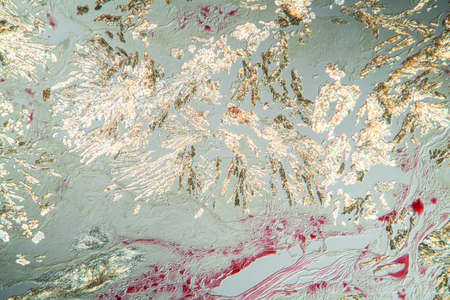 Arthritis gout crystals in the cells tissue section 100xの写真素材