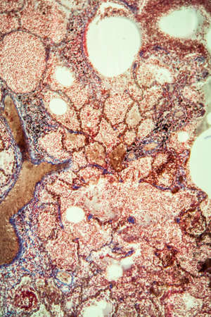 Tuberculosis tissue under the microscope 100x