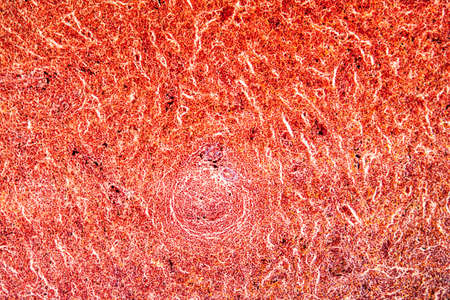 Malaria Melanemia Spleen Diseased Tissue 100x