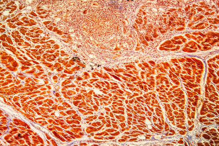 Cardiac muscle inflammation Diseased tissue 100x