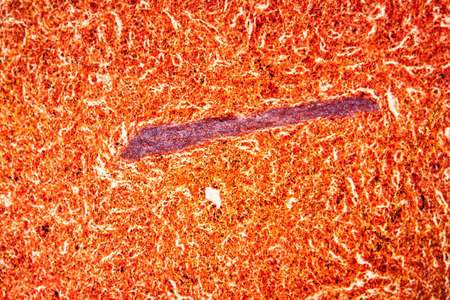 Malaria Melanemia Spleen Diseased Tissue 100x