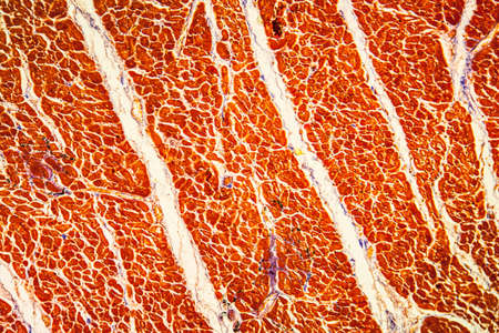 Cardiac muscle inflammation Diseased tissue 100x