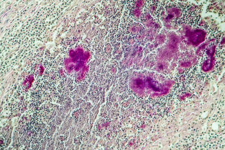 Actinomyces in the jaw diseased tissue 200xの写真素材