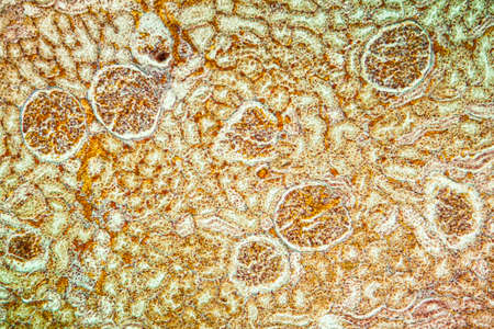 Billirubin kidney Diseased tissue 100x