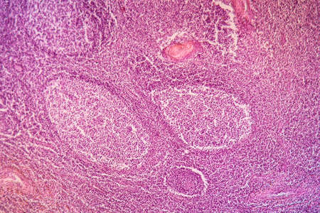 Palate tonsils inflammation diseased tissue 100x