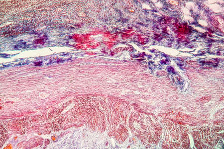Appendicitis inflammation diseased tissue 100x