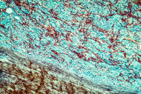 inflammation of the colon diseased tissue 100xの写真素材