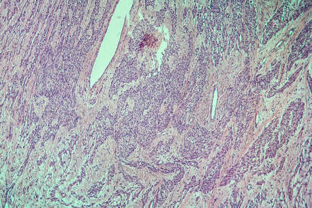 Fibromyoma of the uterus diseased tissue 100x