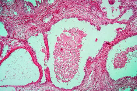 Prostate enlargement diseased tissue 100x