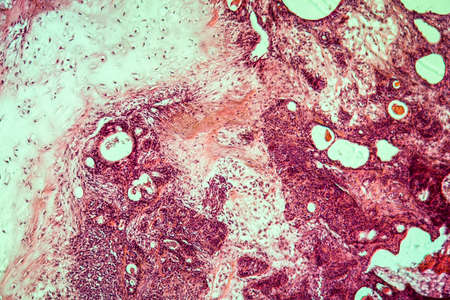 Cancer swollen Parotid diseased tissue 100xの写真素材
