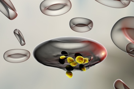 Malaria. Release of malaria parasites from red blood cell. Merozoites of Plasmodium falciparum, Plasmodium vivax, Plasmodium malariae or Plasmodium ovaleの写真素材