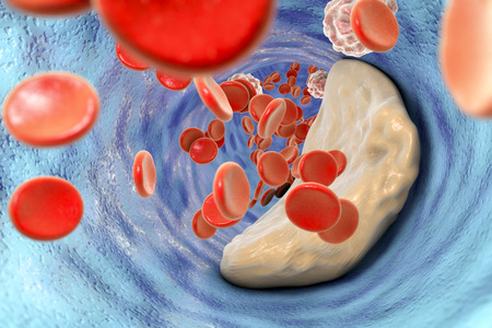 Atheroma plaque inside artery. 3D illustration which can be used for coronary artery disease, atherosclerosis, cerebral infarctionの写真素材
