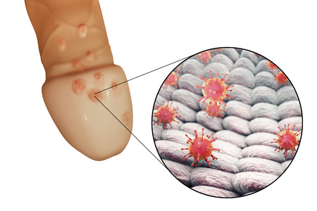 Genital herpes lesions and close-up view of herpes simplex viruses attaching to human cells, 3D illustrationの写真素材