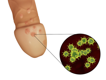 Genital herpes lesions and close-up view of herpes simplex viruses attaching to human cells, 3D illustrationの写真素材