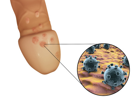 Genital herpes lesions and close-up view of herpes simplex viruses attaching to human cells, 3D illustrationの写真素材