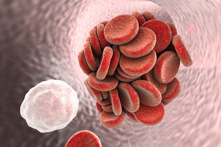 Thromboembol in blood vessel. Clot formation. Red blood cells and white blood cells, 3D illustration