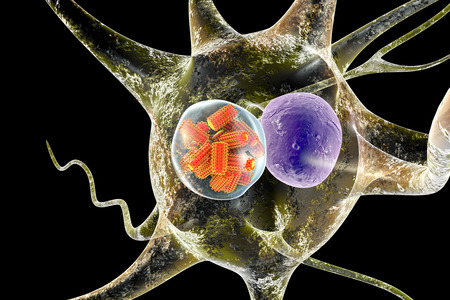 Rabies viruses, orange in neuron. Intracytoplasmic inclusion called Negri body used in diagnostics,...