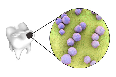 Tooth with dental caries and close-up view of microbes which cause caries Streptococcus mutans, 3D...
