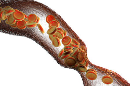 Vasoconstriction, clot formation. Red blood cells flowing through blood vessel isolated on white background, 3D illustrationの写真素材