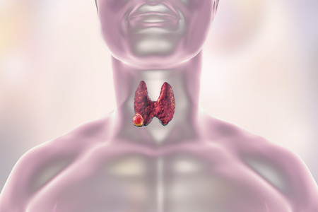 Thyroid cancer. 3D illustration showing thyroid gland with tumor inside human bodyの写真素材
