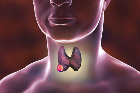 Thyroid cancer. 3D illustration showing thyroid gland with tumor inside human bodyの写真素材