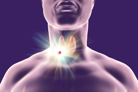 Destruction of thyroid tumor, 3D illustration. Conceptual image for thyroid cancer treatmentの写真素材