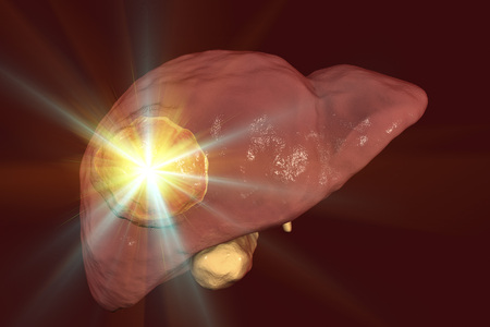 Liver cancer treatment. Conceptual image. 3D illustrationの写真素材