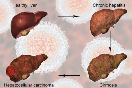 Liver disease progression in Hepatitis C virus infection, 3D illustrationの写真素材