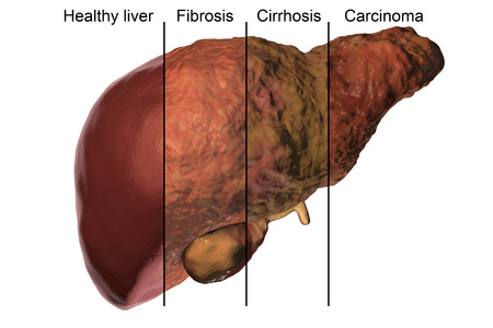 Liver disease progression in Hepatitis B and C viral infection, 3D illustrationの写真素材
