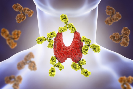 Autoimmune thyroiditis, Hashimoto's disease. 3D illustration showing antibodies attacking thyroid...