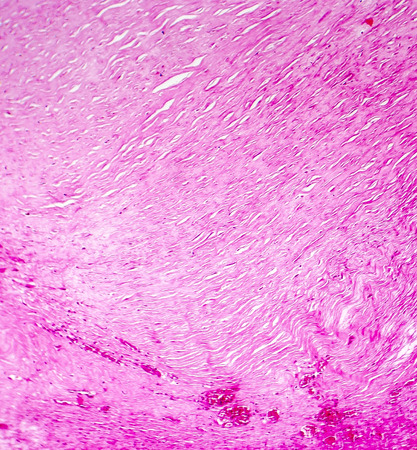 Myxoid degeneration of heart valve, light photomicrograph. Histophatological feature is attenuation of fibrosa layer and deposition of myxomatous material inside middle spongiosa layer of heart valveの写真素材
