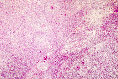 Liquefactive necrosis of the human brain, light photomicrograph showing loss of cell outlines, accumulation of cellular debris, macrophage infiltration. Developes in stroke, necrotising encephalitis