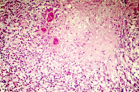 Liquefactive necrosis of the human brain, light photomicrograph showing loss of cell outlines, accumulation of cellular debris, macrophage infiltration. Developes in stroke, necrotising encephalitisの写真素材